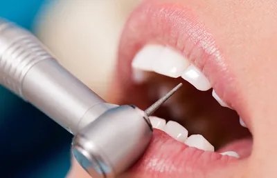 Лечение кариеса клыка и восстановление зуба в стоматологии Виртуоз