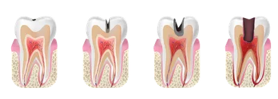 Лечение кариеса зубов в Томске