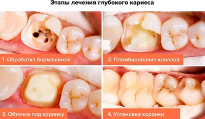 Лечение кариеса в Москве | Стоматология Denta