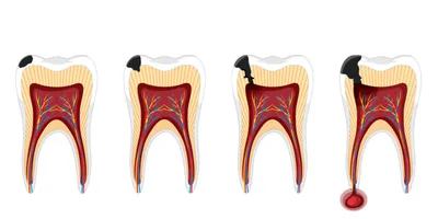 Какие бывают виды кариеса зубов