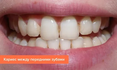 Лечение кариеса в городе Раменское цена от 1600 руб - «New Smile»