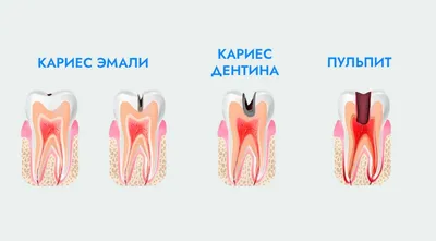 Начальный и поверхностный кариес: симптомы и методы лечения зубов