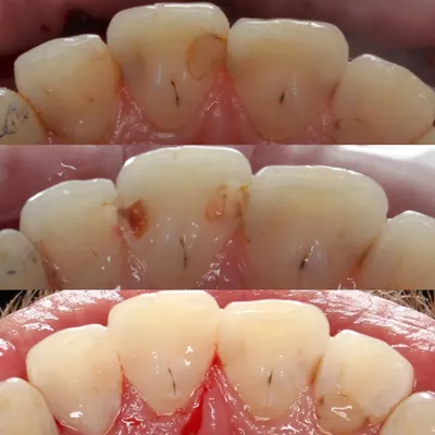 Лечение глубокого кариеса, фото до и после, пример работы 37629