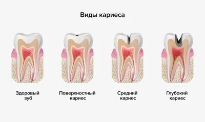 Кариес передних зубов | Стоматология в Красноярске \"ВОКА\" -  стоматологическая клиника