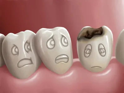Фото до и после: лечение контактного кариеса на передних зубах - Happy Dents