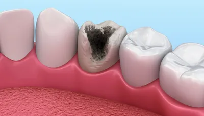 Лечение кариеса зубов: цены | Стоматологическая клиника «Улыбка» в Оренбурге