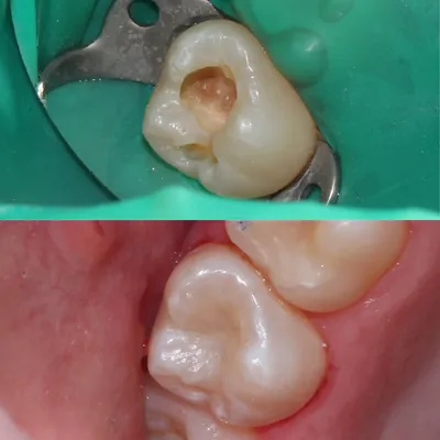 Методы лечения кариеса - детская стоматология \"Рудента\"