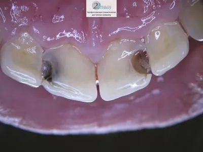 Глубокий кариес - Терапевтическая стоматология - «Аксиома Дентал»