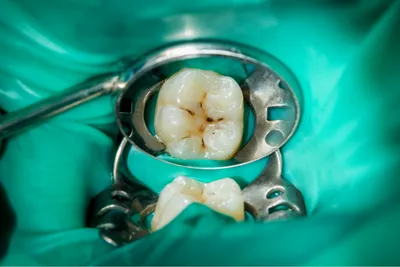 Контактный кариес молочных зубов: профилактика и лечение в СПб