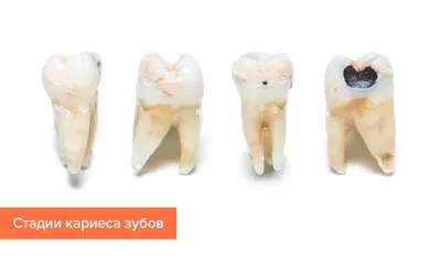 Пришеечный кариес фото, как лечить, причины возникновения | Dental Art