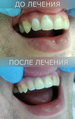 Фото до и после: лечение глубокого кариеса под микроскопом - Happy Dents