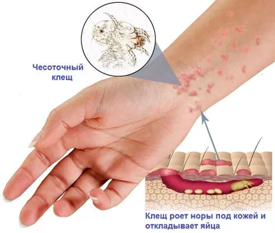 Кого клещи кусают реже?