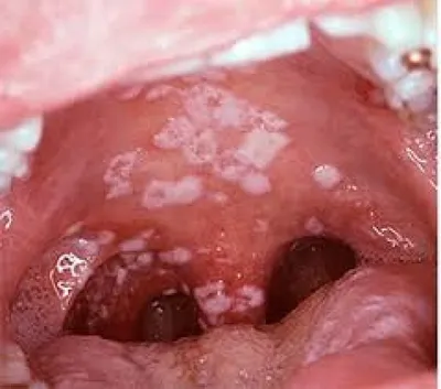 Лейкоплакия рта - причины, симптомы, формы, диагностика, лечение