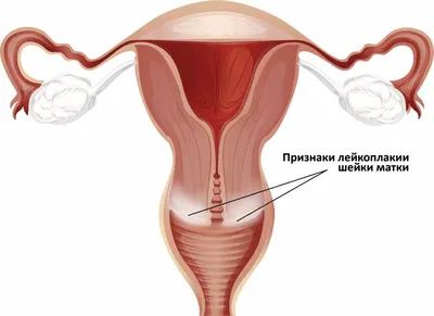 Лейкоплакия мочевого пузыря: причины, симптомы, методы лечения и операции у  женщин и мужчин