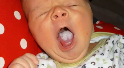 Фото молочницы во рту у ребенка фотографии