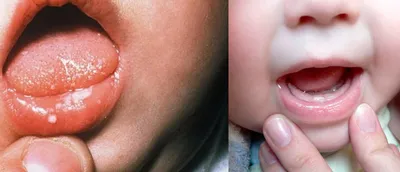 Кандидозный стоматит у детей | Причины, симптомы, лечение | Клиника  семейной стоматологии Дока-Дент