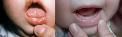 Молочница полости рта: причины, симптомы, лечение