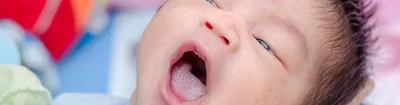Способы лечения молочницы у новорожденного во рту