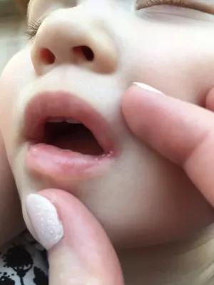 Молочница во рту у ребёнка 1.5 — 15 ответов | форум Babyblog