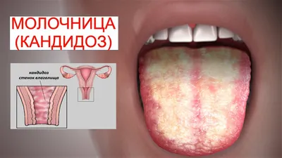Молочница полости рта у детей – гель Холисал® от молочницы во рту у  грудничков