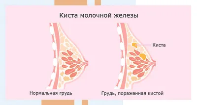 Диагностика опухолей молочных желез – Медицинский центр ЭЛИТМЕД Мытищи