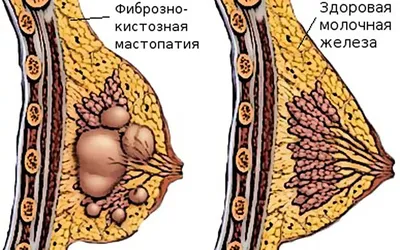 Профилактика рака молочной железы