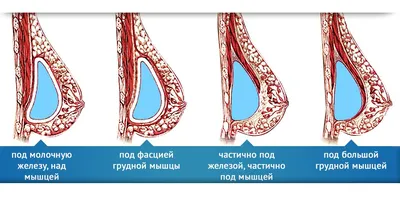 Самодиагностика молочных желез | Доктор Назимова | Дзен