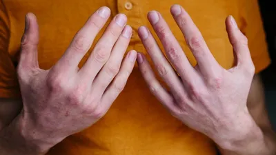 ЧТО СЛУЧИЛОСЬ С МОЕЙ РУКОЙ?/Обморожение Пальцев! 4 степени/ГРИМ/Rola Roys -  YouTube