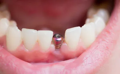 Фото отторжения импланта зуба фотографии