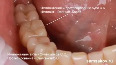 Импланты зубов, методы имплантации — виды и цены в Москве