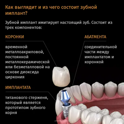 Воспаление вокруг импланта. Что покажет КТ? - Диагностический кабинет 3D KT+