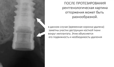 Когда нужно делать имплантацию зубов и костную пластику - Немецкий  имплантологический центр