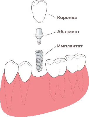 Имплантация зубов в Воронеже — виды, цены и отзывы на импланты зубов