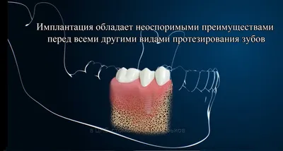 Имплантация зубов под ключ за 35.900 ₽ в Самаре