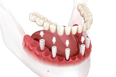 Имплантация зубов. Часто задаваемые вопросы | Стоматология Багита