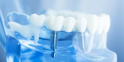 Имплантация зубов | Установить имплантат зуба в стоматологии BrainMark  Dental Studio под ключ, цена в Москве