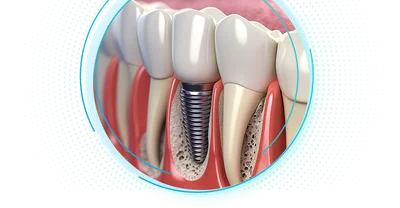 Имплантация зубов: виды и цены в Москве, установка под ключ.