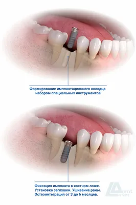 Базальная имплантация зубов Киев, Бровары - недорого, цена