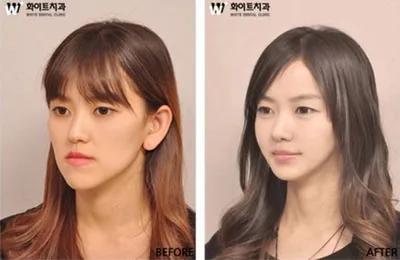 Фотофакты. Другое лицо: до и после чуда корейской пластической хирургии