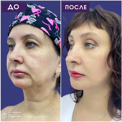 результат до и после пластической хирургии. три портрета кавказской  женщины, показывающие этапы омоложения Стоковое Изображение - изображение  насчитывающей линия, вызревание: 222847427