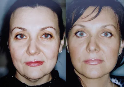 Зрелая женщина до и после операции на белом фоне пластической хирургии.  Проблема двойной подбородок Стоковое Изображение - изображение  насчитывающей полный, внимательность: 170336237