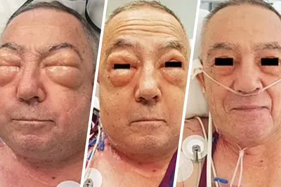 После операции на легком пожилой австралиец стал похож на Вия - Газета.Ru |  Новости