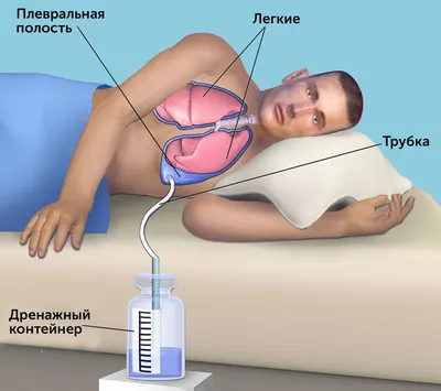 Резекция доли легкого в израильской клинике Ихилов : Armedical