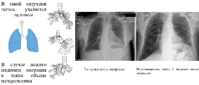 Пластика груди после удаления - Майский И. А.