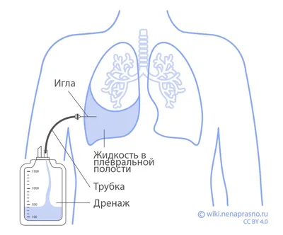 Коронарное шунтирование — Википедия