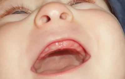 Фото прорезывания зубов у младенцев фотографии