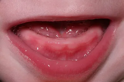 Прорезывание зубов у детей: когда начинается, порядок, сроки, как помочь  ребенку