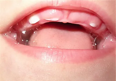 СЖДБ - Первые признаки прорезывания зубов Первые признаки прорезывания зубов  – это сильное слюноотделение, болезненные, опухшие десны. Эти симптомы прорезывания  зубов могут появиться еще за месяц или два до того, как зуб