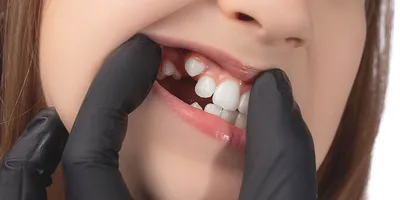 Прорезывание зубов у детей, симптомы, что делать