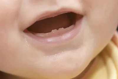 Прорезывание зубов у детей – симптомы, что нужно знать